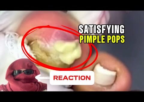10 Minutes of Deep Pimple Popping & Blackhead Removal
