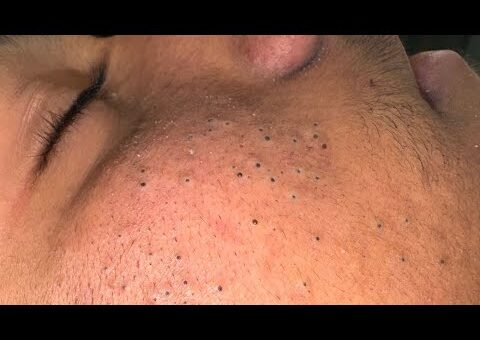 SATISFYING Blackhead Removal & Pimple Popping | Best Acne Treatment and Solutions
