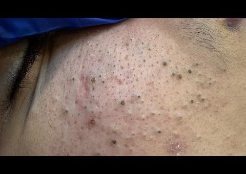 ASMR Deep Cleansing for Acne-Free Skin – Pimple Popping & Blackheads Removal Techniques