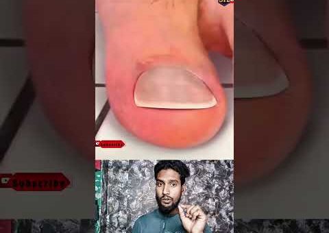 ভুলভাবে নখ কাটলে ইনফেকশনের ঝুঁকি বাড়তে পারে😮✂️ #youtubeshorts #viralvideo #trendingnow #samtheloser