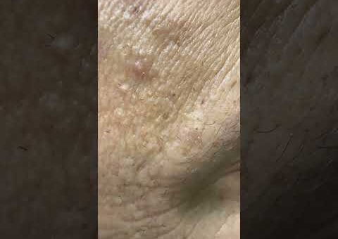 Skincare satisfying videos #hairremoval #beard #pimplepopping #blackheads #acneproneskin pt 23